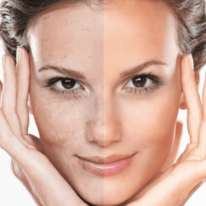 Types of Skin Rejuvenation Treatments | Laser Skin & Vein Clinic in Adelaide