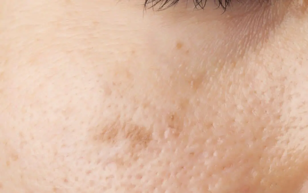 Skin Rejuvenation Treatments | Laser Skin & Vein Clinic