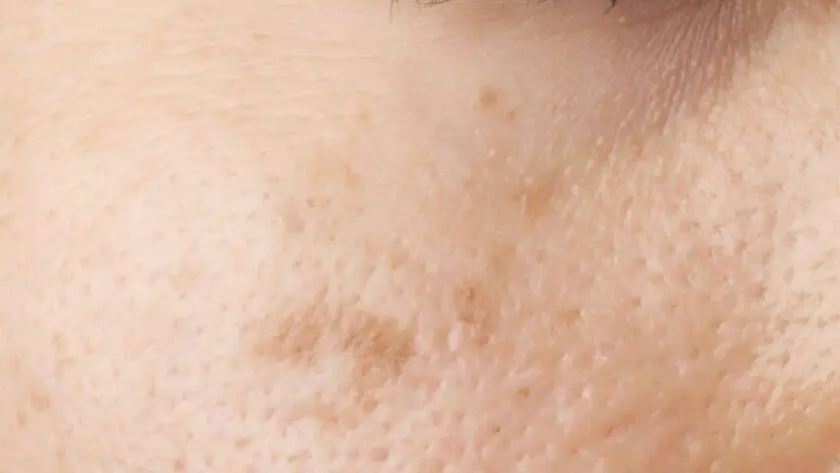 cosmetic treatments for acne scars - laser skin and vein