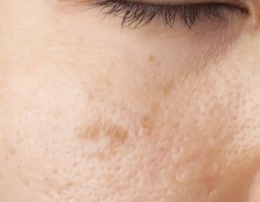 cosmetic treatments for acne scars - laser skin and vein