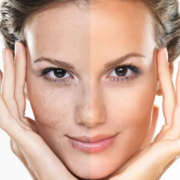 laser skin clinic adelaide treatments